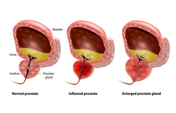 inflammation of the prostate is inflammation of the prostate gland