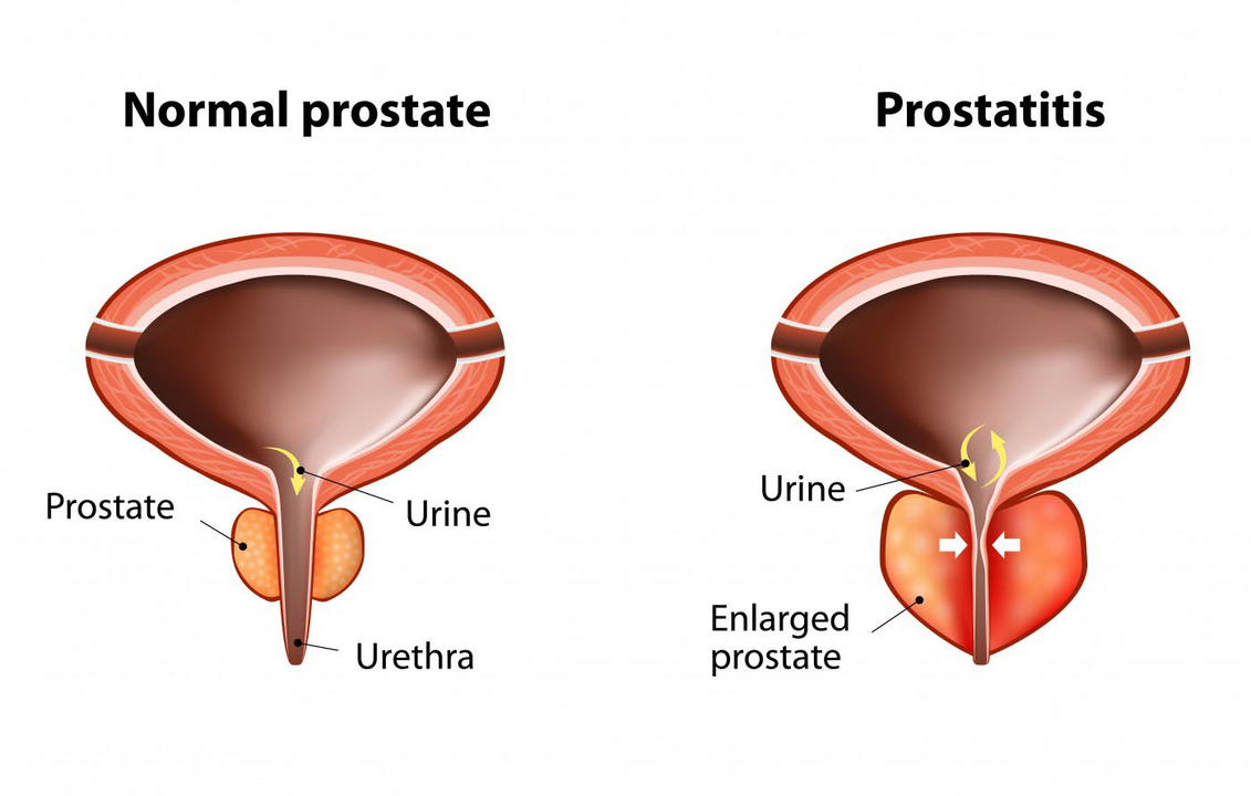 Healthy male normal prostate and prostatitis with prostatitis
